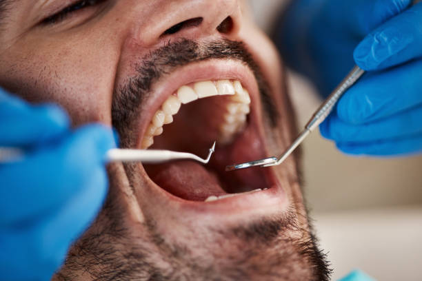 Best Emergency Broken Tooth Repair in Edmundson, MO