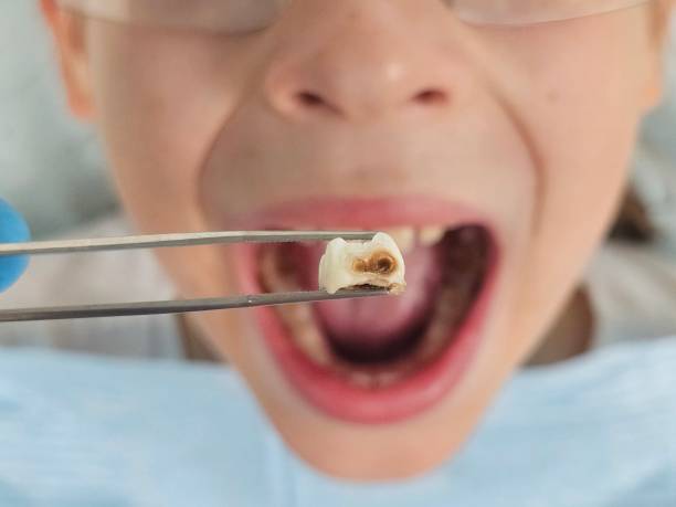 Best Emergency Treatment for Toothache in Edmundson, MO